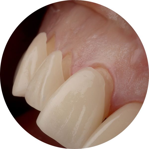 facetas-dentarias